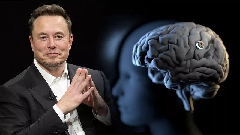 Elon Musk: Ugrađen prvi implantat u mozak čoveka